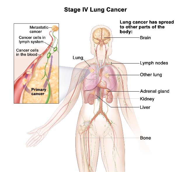 metastatic-lung-cancer-symptom-diagnosis-and-treatment-new-health